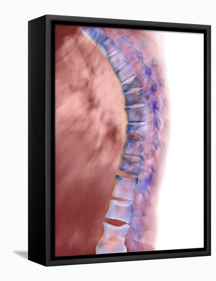 Osteoporosis of the Back, X-ray-Science Photo Library-Framed Premier Image Canvas