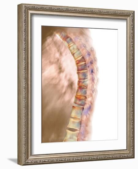 Osteoporosis of the Back, X-ray-Science Photo Library-Framed Photographic Print