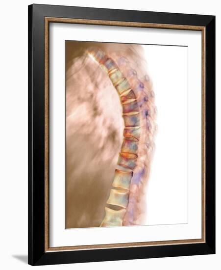 Osteoporosis of the Back, X-ray-Science Photo Library-Framed Photographic Print