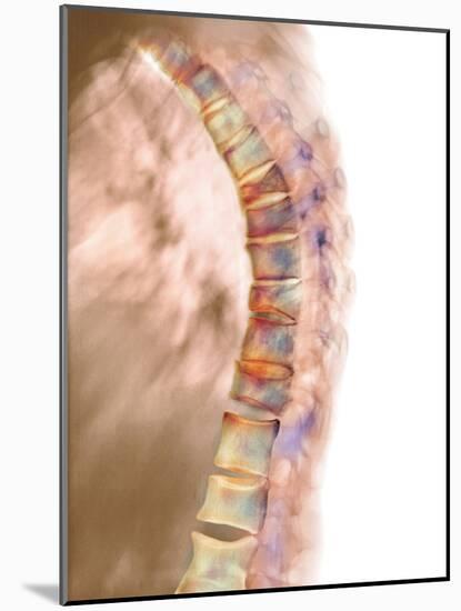 Osteoporosis of the Back, X-ray-Science Photo Library-Mounted Photographic Print