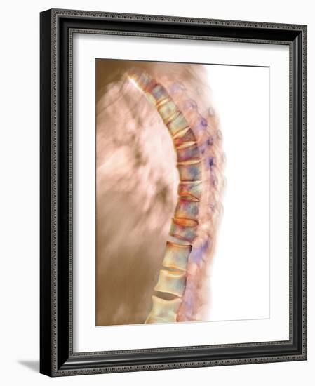 Osteoporosis of the Back, X-ray-Science Photo Library-Framed Photographic Print