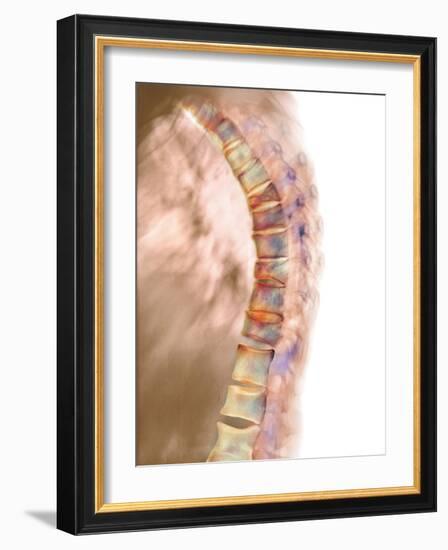 Osteoporosis of the Back, X-ray-Science Photo Library-Framed Photographic Print