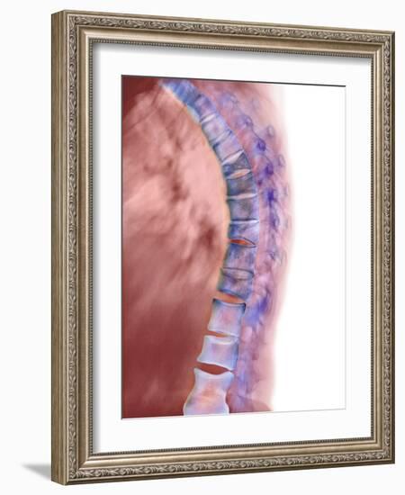 Osteoporosis of the Back, X-ray-Science Photo Library-Framed Photographic Print