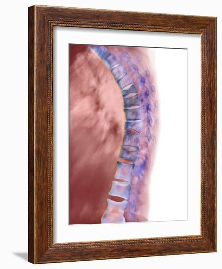 Osteoporosis of the Back, X-ray-Science Photo Library-Framed Photographic Print