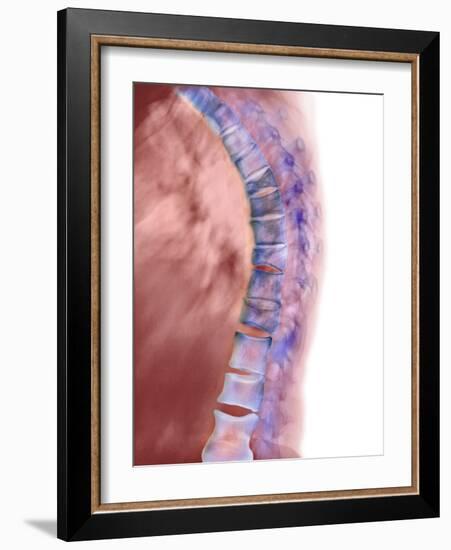 Osteoporosis of the Back, X-ray-Science Photo Library-Framed Photographic Print