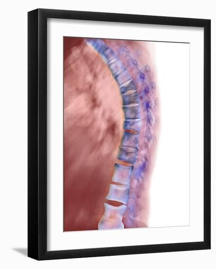 Osteoporosis of the Back, X-ray-Science Photo Library-Framed Photographic Print