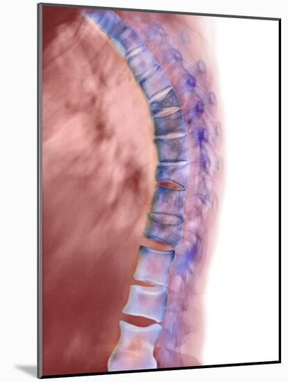 Osteoporosis of the Back, X-ray-Science Photo Library-Mounted Photographic Print