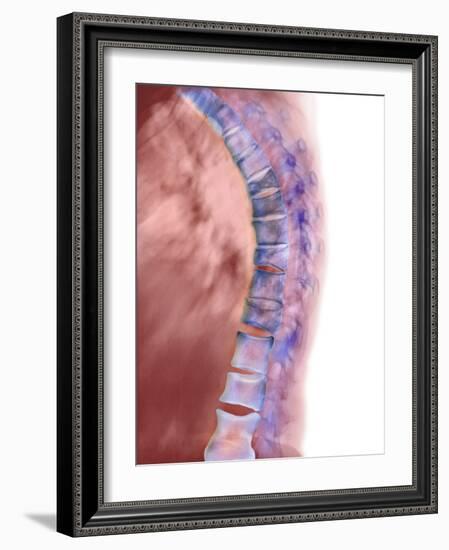 Osteoporosis of the Back, X-ray-Science Photo Library-Framed Photographic Print