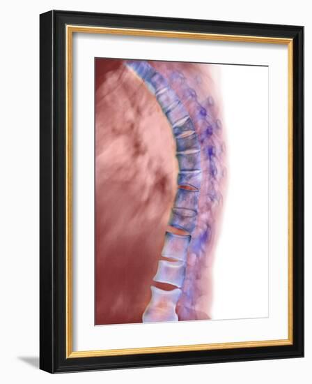 Osteoporosis of the Back, X-ray-Science Photo Library-Framed Photographic Print