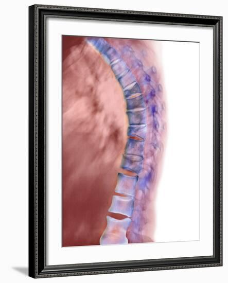 Osteoporosis of the Back, X-ray-Science Photo Library-Framed Photographic Print