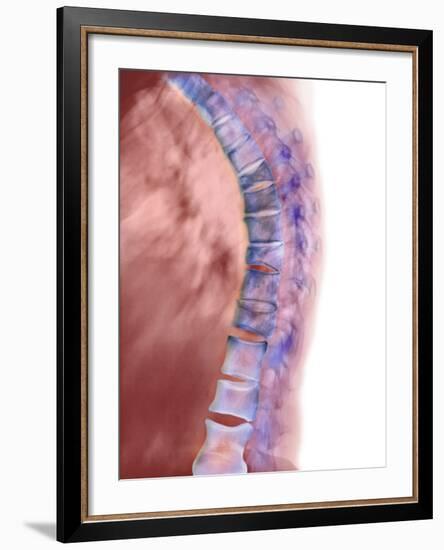 Osteoporosis of the Back, X-ray-Science Photo Library-Framed Photographic Print