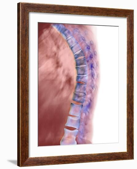 Osteoporosis of the Back, X-ray-Science Photo Library-Framed Photographic Print