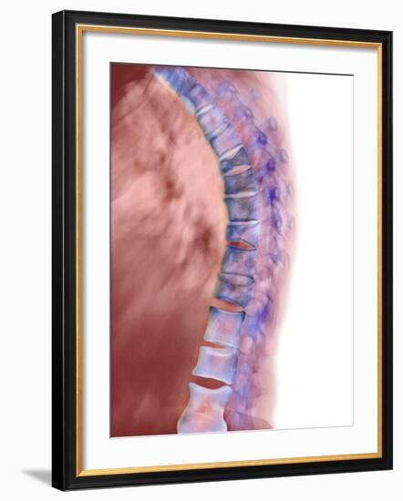 Osteoporosis of the Back, X-ray-Science Photo Library-Framed Photographic Print