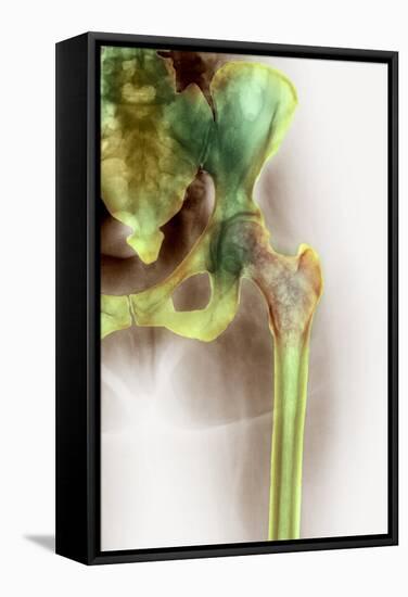 Osteoporosis of the Hip, X-ray-Science Photo Library-Framed Premier Image Canvas