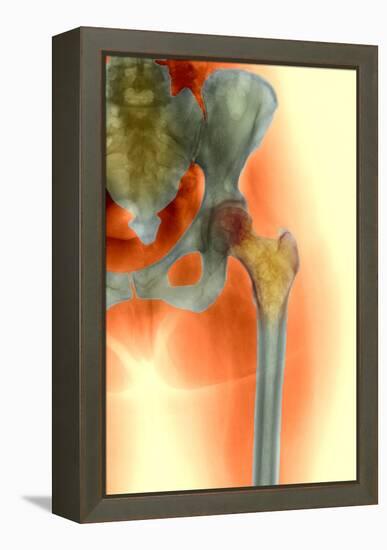 Osteoporosis of the Hip, X-ray-Science Photo Library-Framed Premier Image Canvas