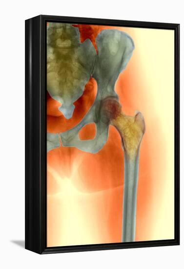 Osteoporosis of the Hip, X-ray-Science Photo Library-Framed Premier Image Canvas