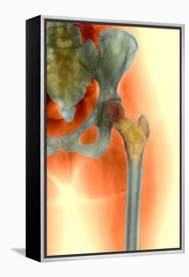 Osteoporosis of the Hip, X-ray-Science Photo Library-Framed Premier Image Canvas