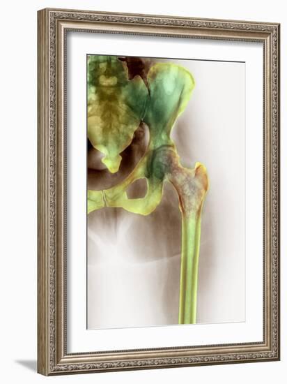 Osteoporosis of the Hip, X-ray-Science Photo Library-Framed Photographic Print