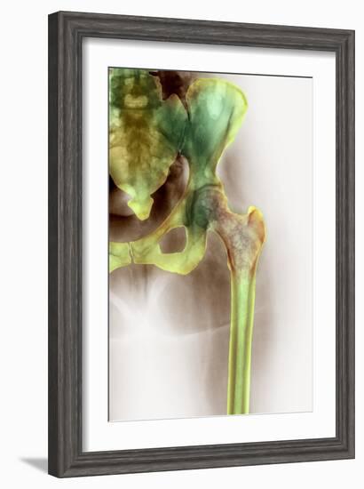 Osteoporosis of the Hip, X-ray-Science Photo Library-Framed Photographic Print