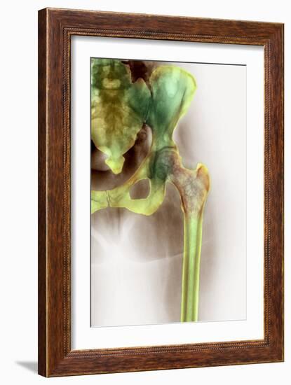 Osteoporosis of the Hip, X-ray-Science Photo Library-Framed Photographic Print