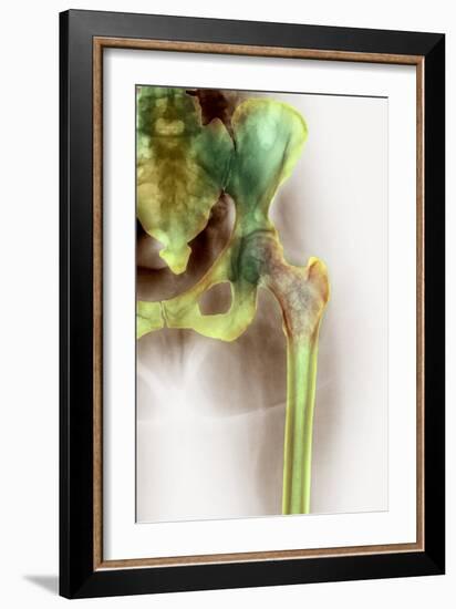 Osteoporosis of the Hip, X-ray-Science Photo Library-Framed Photographic Print