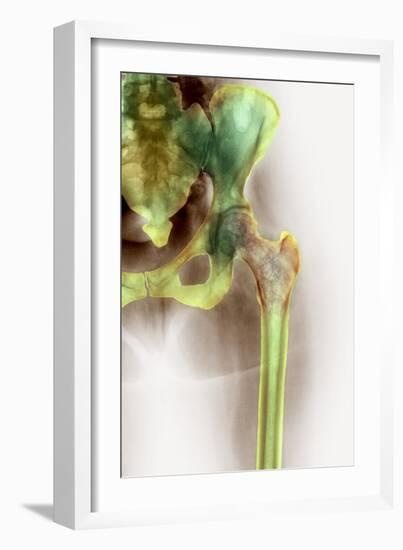 Osteoporosis of the Hip, X-ray-Science Photo Library-Framed Photographic Print