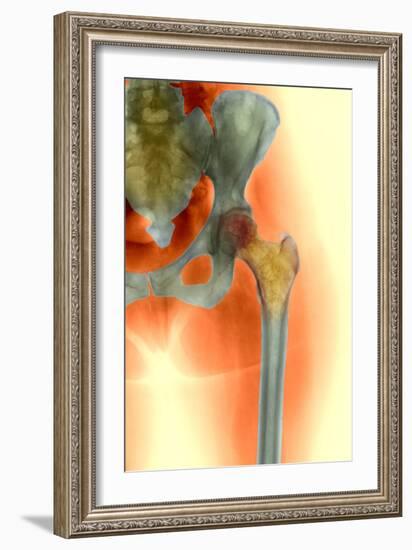 Osteoporosis of the Hip, X-ray-Science Photo Library-Framed Photographic Print