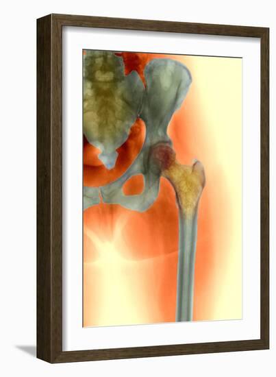Osteoporosis of the Hip, X-ray-Science Photo Library-Framed Photographic Print