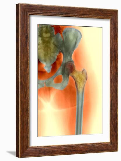 Osteoporosis of the Hip, X-ray-Science Photo Library-Framed Photographic Print