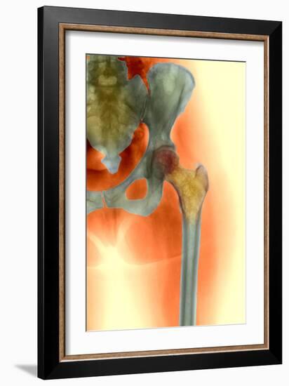 Osteoporosis of the Hip, X-ray-Science Photo Library-Framed Photographic Print