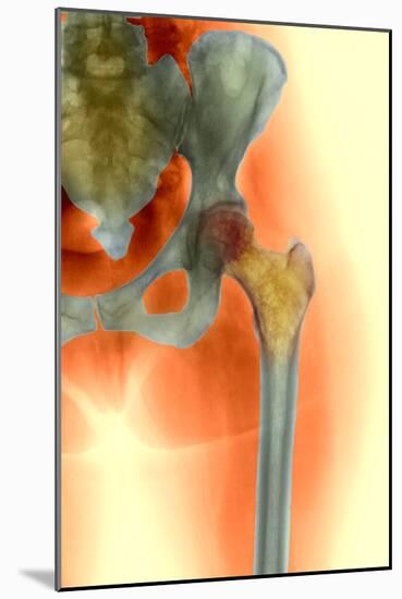 Osteoporosis of the Hip, X-ray-Science Photo Library-Mounted Photographic Print