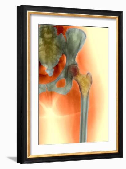 Osteoporosis of the Hip, X-ray-Science Photo Library-Framed Photographic Print