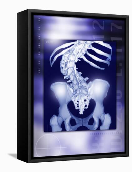 Osteoporosis of the Spine, CT Scan-Miriam Maslo-Framed Premier Image Canvas