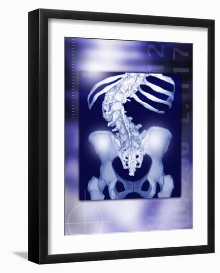 Osteoporosis of the Spine, CT Scan-Miriam Maslo-Framed Photographic Print