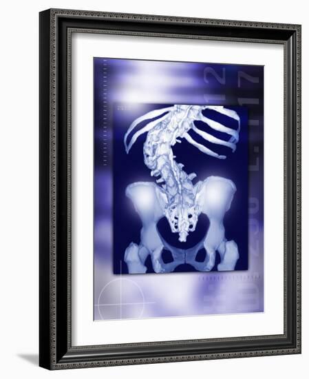 Osteoporosis of the Spine, CT Scan-Miriam Maslo-Framed Photographic Print