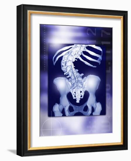 Osteoporosis of the Spine, CT Scan-Miriam Maslo-Framed Photographic Print