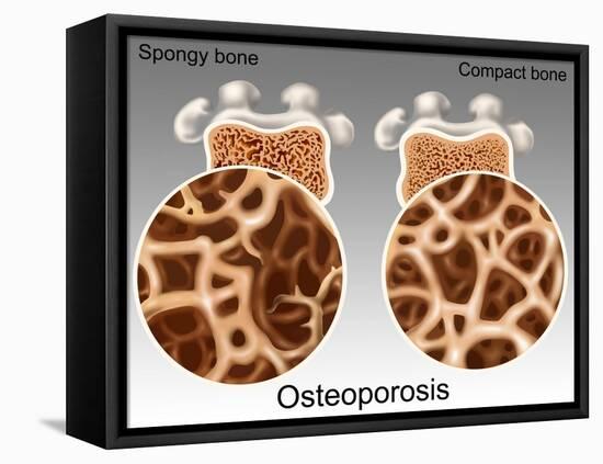 Osteoporotic & Normal Bone-Gwen Shockey-Framed Premier Image Canvas