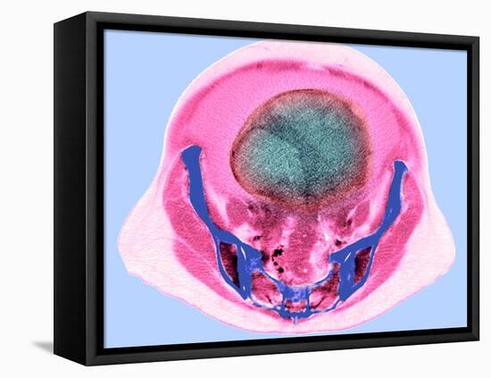 Ovarian Cancer, CT Scan-Du Cane Medical-Framed Premier Image Canvas