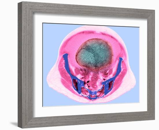 Ovarian Cancer, CT Scan-Du Cane Medical-Framed Photographic Print