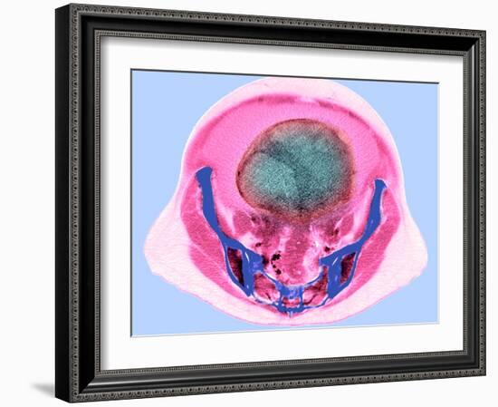Ovarian Cancer, CT Scan-Du Cane Medical-Framed Photographic Print
