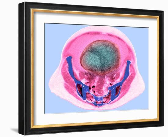 Ovarian Cancer, CT Scan-Du Cane Medical-Framed Photographic Print