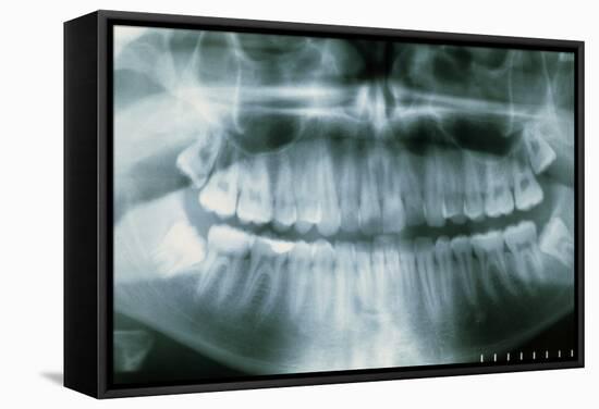 Panoramic Dental X-ray of Impacted Wisdom Teeth-Kaj Svensson-Framed Premier Image Canvas