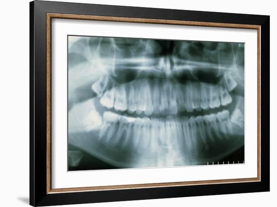 Panoramic Dental X-ray of Impacted Wisdom Teeth-Kaj Svensson-Framed Photographic Print