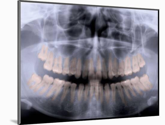 Panoramic X-Ray of Mouth-null-Mounted Photographic Print