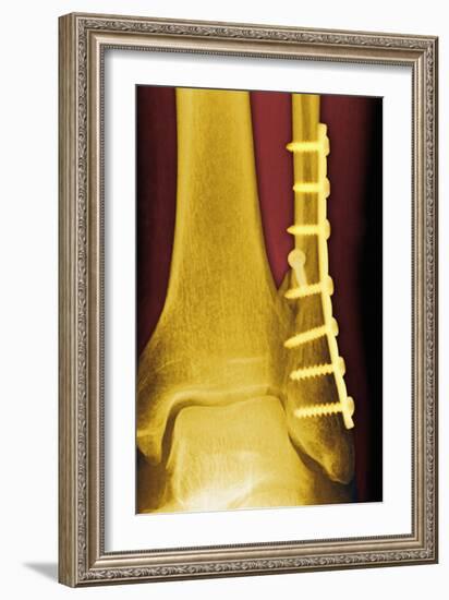 Pinned Ankle Fracture, Coloured X-ray-Miriam Maslo-Framed Photographic Print