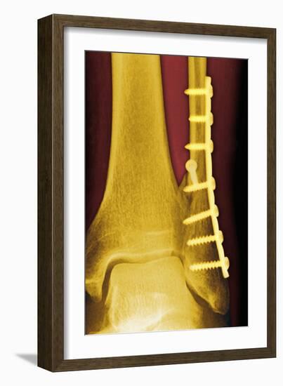 Pinned Ankle Fracture, Coloured X-ray-Miriam Maslo-Framed Photographic Print