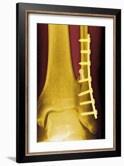 Pinned Ankle Fracture, Coloured X-ray-Miriam Maslo-Framed Photographic Print