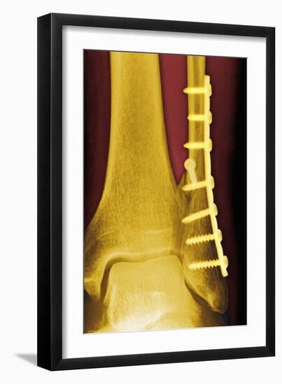 Pinned Ankle Fracture, Coloured X-ray-Miriam Maslo-Framed Photographic Print