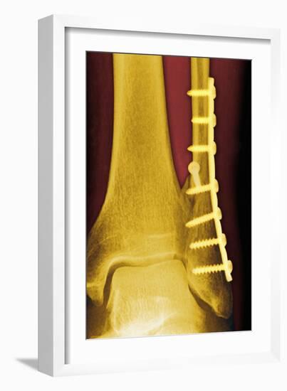 Pinned Ankle Fracture, Coloured X-ray-Miriam Maslo-Framed Photographic Print