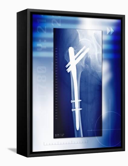 Pinned Broken Leg, X-ray-Miriam Maslo-Framed Premier Image Canvas